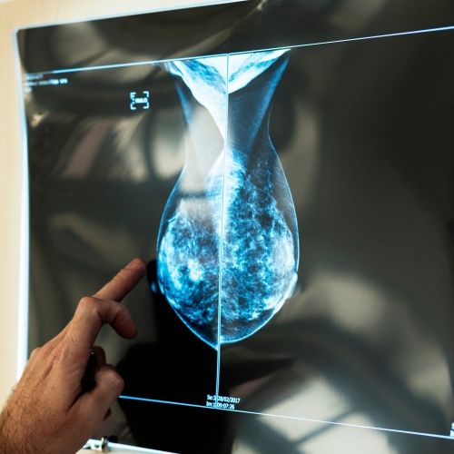 Elmore_breast cancer_JNCI
